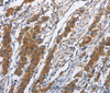 Immunohistochemistry of paraffin-embedded Human gasrtic cancer tissue using NCAPD3 Polyclonal Antibody at dilution 1:50