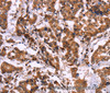 Immunohistochemistry of paraffin-embedded Human breast cancer tissue using CARD11 Polyclonal Antibody at dilution 1:40