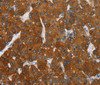 Immunohistochemistry of paraffin-embedded Human liver cancer tissue using CARD9 Polyclonal Antibody at dilution 1:70