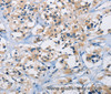 Immunohistochemistry of paraffin-embedded Human thyroid cancer using CARD14 Polyclonal Antibody at dilution of 1:30