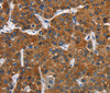 Immunohistochemistry of paraffin-embedded Human liver cancer tissue using CATSPER3 Polyclonal Antibody at dilution 1:60