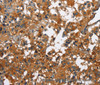 Immunohistochemistry of paraffin-embedded Human thyroid cancer tissue using CATSPER3 Polyclonal Antibody at dilution 1:60