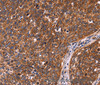 Immunohistochemistry of paraffin-embedded Human cervical cancer tissue using CCDC106 Polyclonal Antibody at dilution 1:60