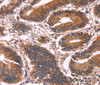 Immunohistochemistry of paraffin-embedded Human colon cancer tissue using CCDC106 Polyclonal Antibody at dilution 1:60