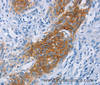 Immunohistochemistry of paraffin-embedded Human esophagus cancer tissue using CCR9 Polyclonal Antibody at dilution 1:60