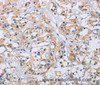Immunohistochemistry of paraffin-embedded Human thyroid cancer tissue using CCR9 Polyclonal Antibody at dilution 1:60
