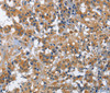 Immunohistochemistry of paraffin-embedded Human thyroid cancer using IL2RB Polyclonal Antibody at dilution of 1:30
