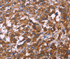 Immunohistochemistry of paraffin-embedded Human thyroid cancer tissue using KIR2DL1/3/4/S4 Polyclonal Antibody at dilution 1:30