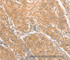 Immunohistochemistry of paraffin-embedded Human gastric cancer tissue using CXCR4 Polyclonal Antibody at dilution 1:50