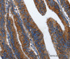Immunohistochemistry of paraffin-embedded Human colon cancer using CD27 Polyclonal Antibody at dilution of 1:60
