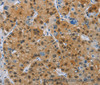 Immunohistochemistry of paraffin-embedded Human liver cancer tissue using CD272 Polyclonal Antibody at dilution 1:30
