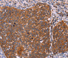 Immunohistochemistry of paraffin-embedded Human cervical cancer tissue using FBXW7 Polyclonal Antibody at dilution 1:40