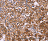 Immunohistochemistry of paraffin-embedded Human thyroid cancer tissue using FBXW7 Polyclonal Antibody at dilution 1:40