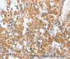Immunohistochemistry of paraffin-embedded Human thyroid cancer tissue using CHMP4B Polyclonal Antibody at dilution 1:40