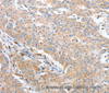Immunohistochemistry of paraffin-embedded Human gastric cancer using WNT3A Polyclonal Antibody at dilution of 1:40