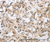 Immunohistochemistry of paraffin-embedded Human thyroid cancer using CKMT2 Polyclonal Antibody at dilution of 1:60