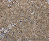 Immunohistochemistry of paraffin-embedded Human esophagus cancer tissue using CLPS Polyclonal Antibody at dilution 1:45