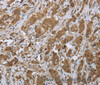 Immunohistochemistry of paraffin-embedded Human breast cancer tissue using CLPS Polyclonal Antibody at dilution 1:45