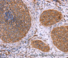 Immunohistochemistry of paraffin-embedded Human cervical cancer tissue using CLUAP1 Polyclonal Antibody at dilution 1:50