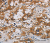 Immunohistochemistry of paraffin-embedded Human thyroid cancer using CNDP1 Polyclonal Antibody at dilution of 1:30