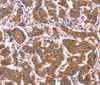 Immunohistochemistry of paraffin-embedded Human breast cancer tissue using COL20A1 Polyclonal Antibody at dilution 1:40