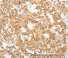 Immunohistochemistry of paraffin-embedded Human thyroid cancer using COL4A3BP Polyclonal Antibody at dilution of 1:60