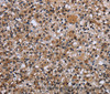 Immunohistochemistry of paraffin-embedded Human prostate cancer using c-Rel Polyclonal Antibody at dilution of 1:30