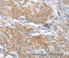 Immunohistochemistry of paraffin-embedded Human gastric cancer using CRELD2 Polyclonal Antibody at dilution of 1:50