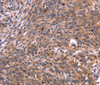 Immunohistochemistry of paraffin-embedded Human cervical cancer tissue using CRK Polyclonal Antibody at dilution 1:40