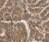 Immunohistochemistry of paraffin-embedded Human breast cancer tissue using CTNNBIP1 Polyclonal Antibody at dilution 1:30