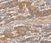Immunohistochemistry of paraffin-embedded Human gasrtic cancer tissue using CUEDC2 Polyclonal Antibody at dilution 1:30