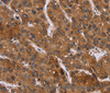 Immunohistochemistry of paraffin-embedded Human liver cancer using PPIB Polyclonal Antibody at dilution of 1:45