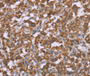 Immunohistochemistry of paraffin-embedded Human thyroid cancer using Cyclophilin F Polyclonal Antibody at dilution of 1:45