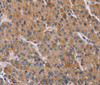 Immunohistochemistry of paraffin-embedded Human liver cancer using Cyclophilin F Polyclonal Antibody at dilution of 1:45