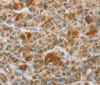 Immunohistochemistry of paraffin-embedded Human liver cancer tissue using CYP27A1 Polyclonal Antibody at dilution 1:50
