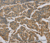 Immunohistochemistry of paraffin-embedded Human breast cancer tissue using TBXAS1 Polyclonal Antibody at dilution 1:30