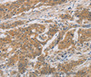 Immunohistochemistry of paraffin-embedded Human ovarian cancer tissue using CST6 Polyclonal Antibody at dilution 1:30
