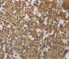 Immunohistochemistry of paraffin-embedded Human thyroid cancer using Cytochrome b5 Polyclonal Antibody at dilution of 1:40