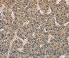 Immunohistochemistry of paraffin-embedded Human liver cancer tissue using DACH2 Polyclonal Antibody at dilution 1:40