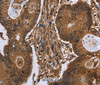 Immunohistochemistry of paraffin-embedded Human colon cancer tissue using DCP1A Polyclonal Antibody at dilution 1:50