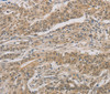 Immunohistochemistry of paraffin-embedded Human gastric cancer tissue using DDIT4 Polyclonal Antibody at dilution 1:30