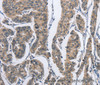 Immunohistochemistry of paraffin-embedded Human breast cancer tissue using DSG2 Polyclonal Antibody at dilution 1:50