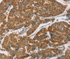 Immunohistochemistry of paraffin-embedded Human breast cancer tissue using DLL4 Polyclonal Antibody at dilution 1:40