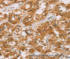 Immunohistochemistry of paraffin-embedded Human thyroid cancer tissue using DLL4 Polyclonal Antibody at dilution 1:40