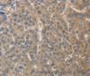Immunohistochemistry of paraffin-embedded Human liver cancer using DPYSL3 Polyclonal Antibody at dilution of 1:30