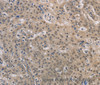 Immunohistochemistry of paraffin-embedded Human gastric cancer using DPYSL3 Polyclonal Antibody at dilution of 1:30