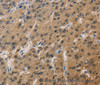 Immunohistochemistry of paraffin-embedded Human liver cancer tissue using DUSP26 Polyclonal Antibody at dilution 1:60