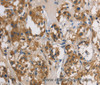 Immunohistochemistry of paraffin-embedded Human thyroid cancer tissue using DUSP26 Polyclonal Antibody at dilution 1:60