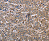 Immunohistochemistry of paraffin-embedded Human liver cancer tissue using EDA Polyclonal Antibody at dilution 1:30