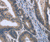 Immunohistochemistry of paraffin-embedded Human colon cancer tissue using KCNJ11 Polyclonal Antibody at dilution 1:40